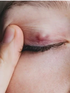 Удаление халязиона радиоволновым скальпелем "SURGITRON ELLMAN" США