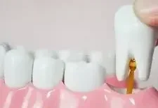 Удаление многокорневого зуба с разделением корней (щадящая методика с сохранением костной ткани)