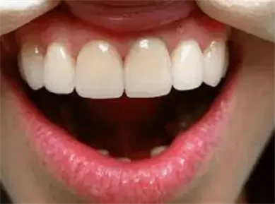 Протезирование зубов: металлокерамическая коронка