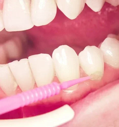 Глубокое фторирование эмали зубов всей полости рта