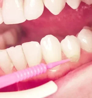 Фото для Глубокое фторирование эмали зубов всей полости рта