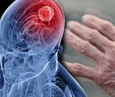 МРТ головного мозга при нейродегенеративных заболеваниях (болезнь альцгеймера, болезнь Паркинсона, деменция)