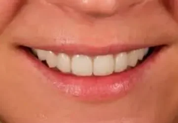 Реставрация коронки зуба линии улыбки