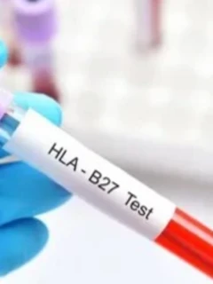 Фото для Анализ крови на HLA-27, методом ПЦР