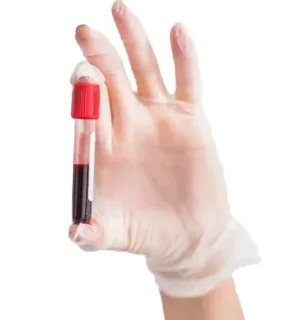 Клинический анализ крови: общий анализ, лейкоформула, СОЭ (с микроскопией мазка крови при наличии патологических сдвигов