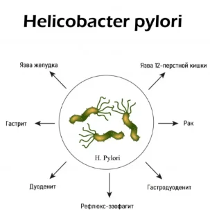 Антитела к Helicobacter pylori: иммуноферментный анализ. Helicobacter Pylori IgM (антитела класса IgM к Helicobacter pyl