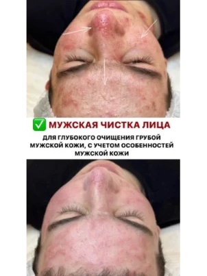 Мужская чистка лица