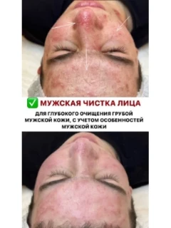 Мужская чистка лица